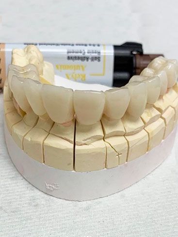 full mouth restoration